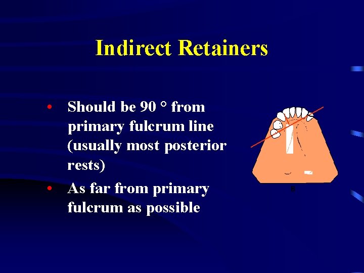 Indirect Retainers • Should be 90 ° from primary fulcrum line (usually most posterior