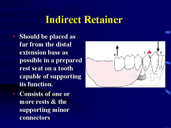 Indirect Retainer • Should be placed as far from the distal extension base as