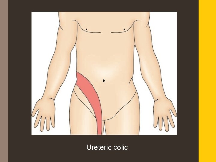 Ureteric colic 