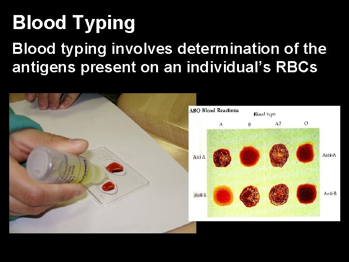 Blood Typing Blood typing involves determination of the antigens present on an individual’s RBCs