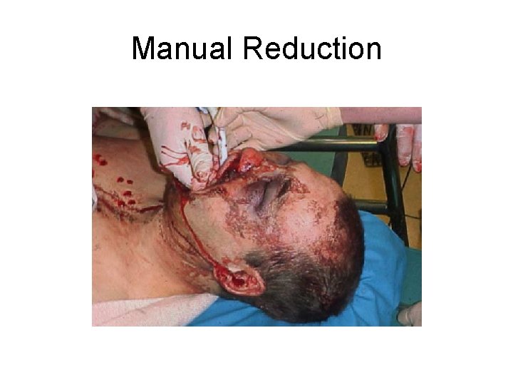 Manual Reduction 