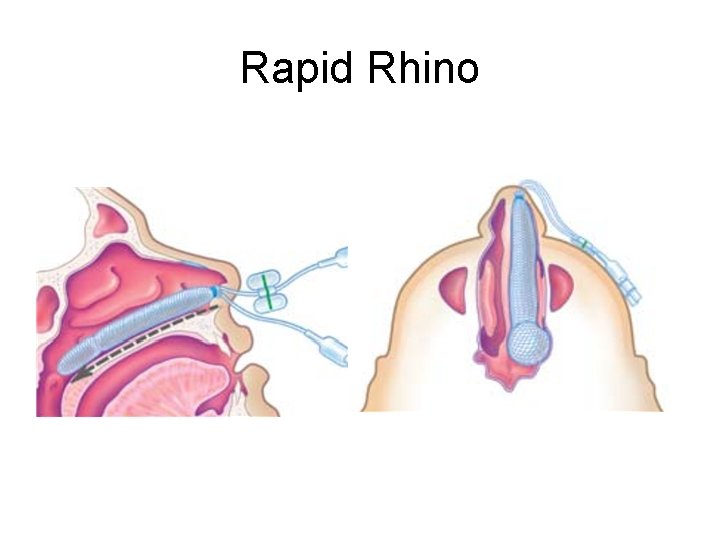 Rapid Rhino 
