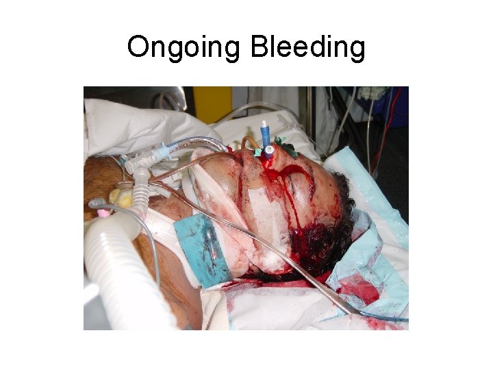 Ongoing Bleeding 