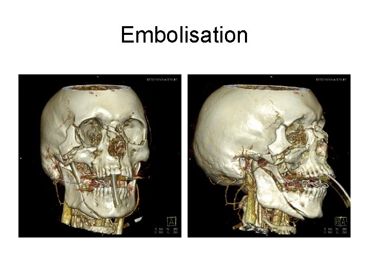 Embolisation 
