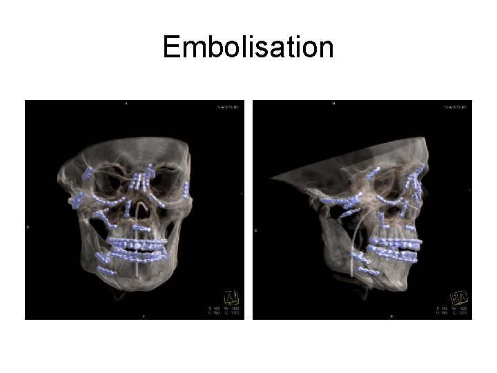 Embolisation 