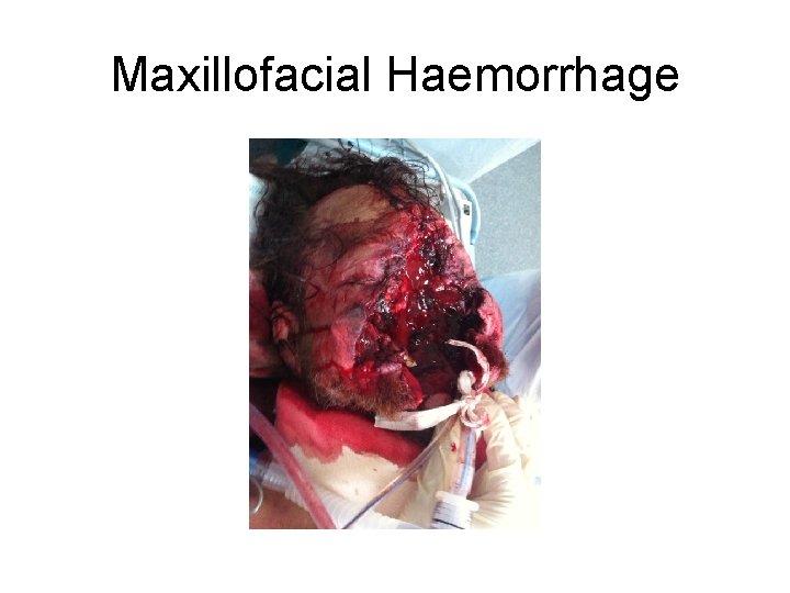 Maxillofacial Haemorrhage 