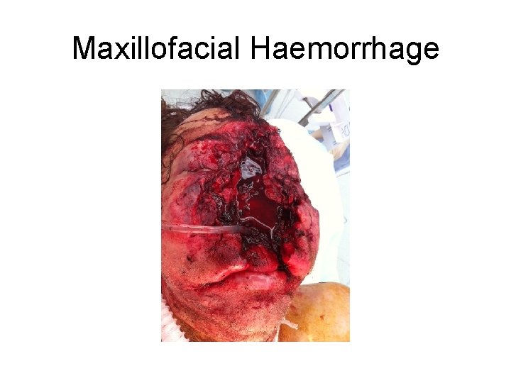 Maxillofacial Haemorrhage 