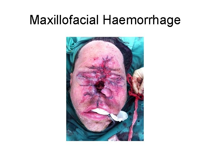 Maxillofacial Haemorrhage 