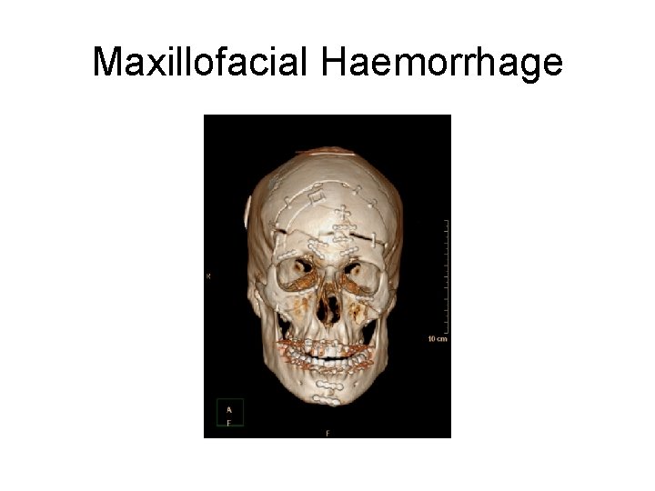 Maxillofacial Haemorrhage 