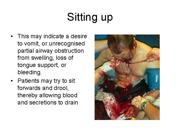 Sitting up • This may indicate a desire to vomit, or unrecognised partial airway