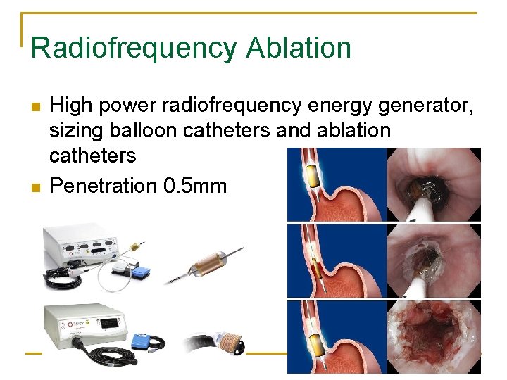 Radiofrequency Ablation n n High power radiofrequency energy generator, sizing balloon catheters and ablation