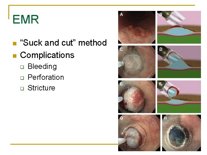 EMR n n “Suck and cut” method Complications q q q Bleeding Perforation Stricture