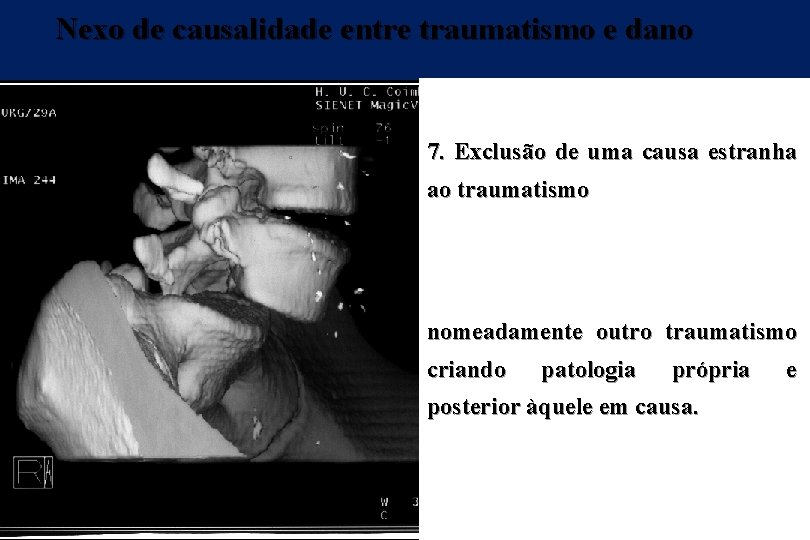 Nexo de causalidade entre traumatismo e dano 7. Exclusão de uma causa estranha ao