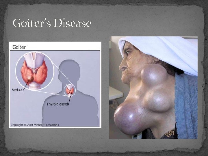 Goiter’s Disease 