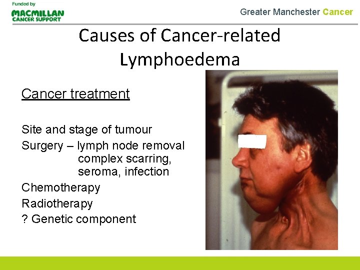 Greater Manchester Cancer Causes of Cancer-related Lymphoedema Cancer treatment Site and stage of tumour
