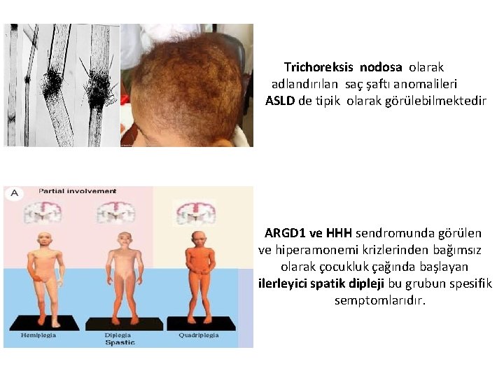 Trichoreksis nodosa olarak adlandırılan saç şaftı anomalileri ASLD de tipik olarak görülebilmektedir ARGD 1