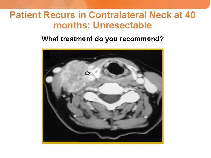 Patient Recurs in Contralateral Neck at 40 months: Unresectable What treatment do you recommend?