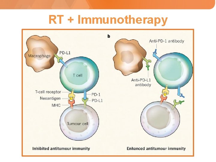 RT + Immunotherapy 