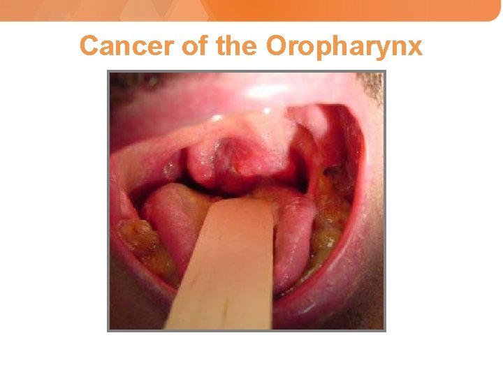 Cancer of the Oropharynx 