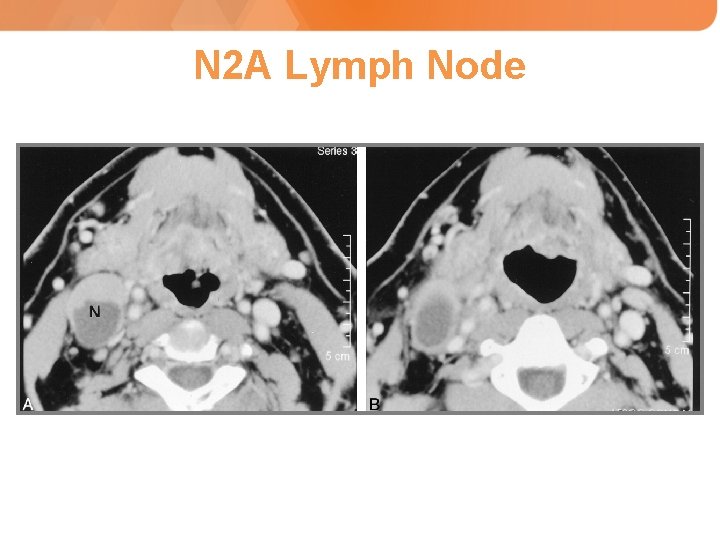 N 2 A Lymph Node 