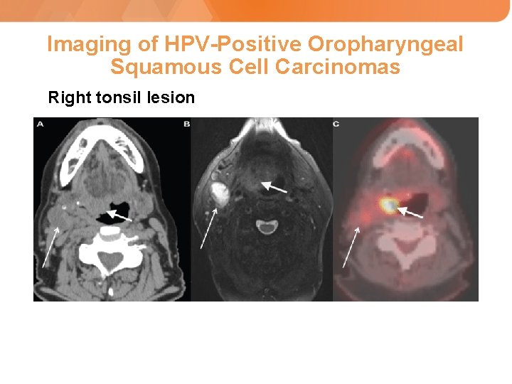 Imaging of HPV-Positive Oropharyngeal Squamous Cell Carcinomas Right tonsil lesion CT of the head