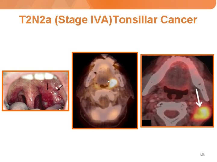 T 2 N 2 a (Stage IVA)Tonsillar Cancer 58 