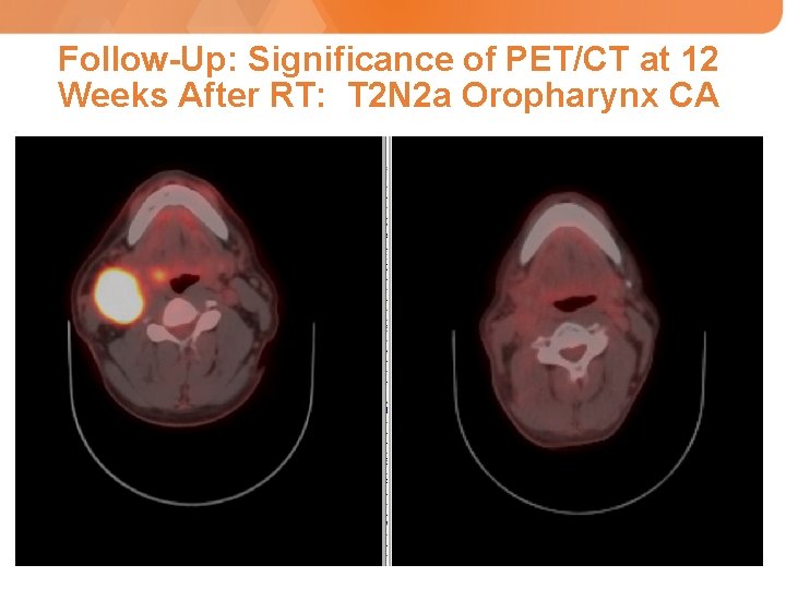 Follow-Up: Significance of PET/CT at 12 Weeks After RT: T 2 N 2 a