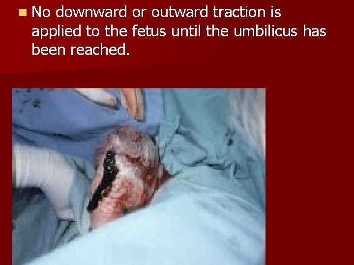 n No downward or outward traction is applied to the fetus until the umbilicus