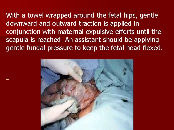 With a towel wrapped around the fetal hips, gentle downward and outward traction is