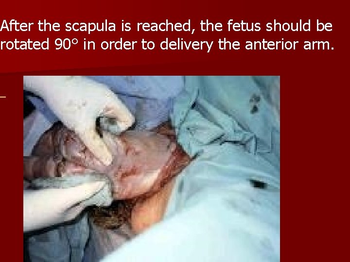 After the scapula is reached, the fetus should be rotated 90° in order to