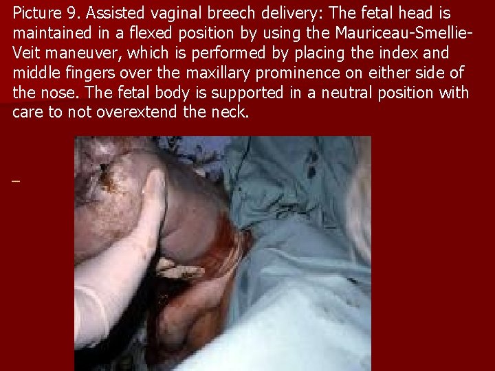 Picture 9. Assisted vaginal breech delivery: The fetal head is maintained in a flexed