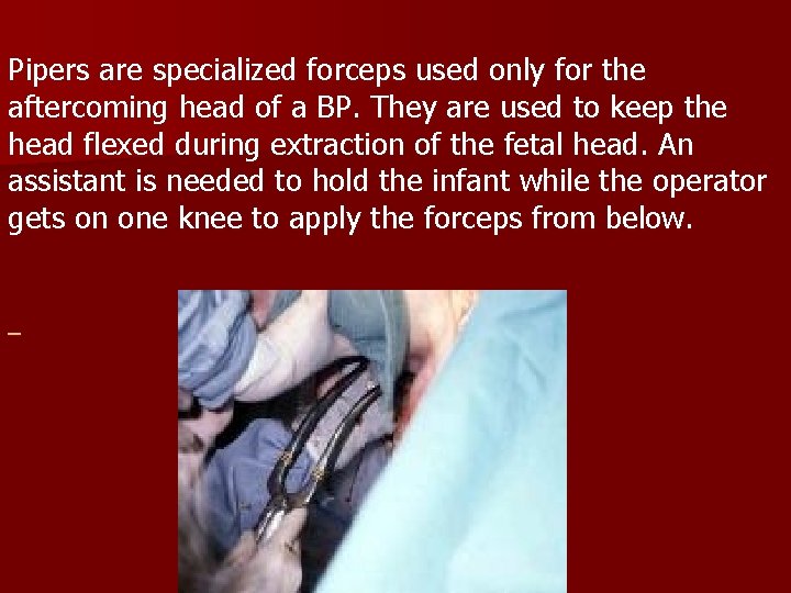 Pipers are specialized forceps used only for the aftercoming head of a BP. They