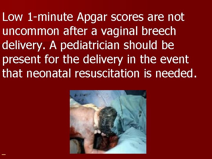 Low 1 -minute Apgar scores are not uncommon after a vaginal breech delivery. A