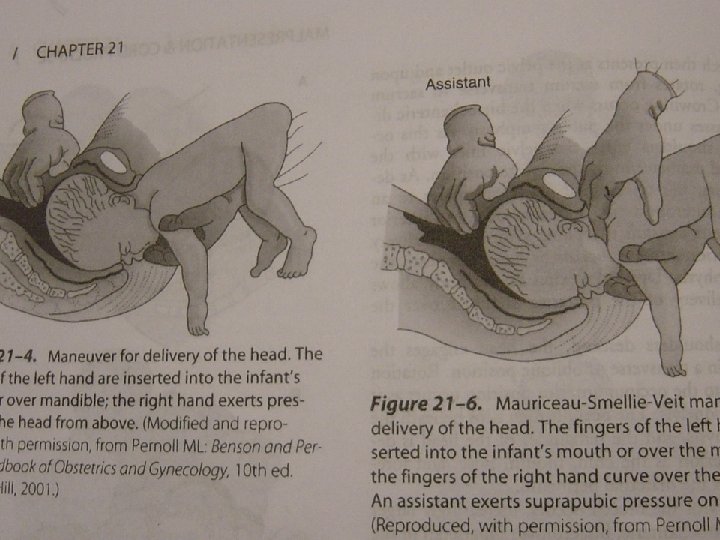 Picture 12. Assisted vaginal breech delivery - The neonate after birth 