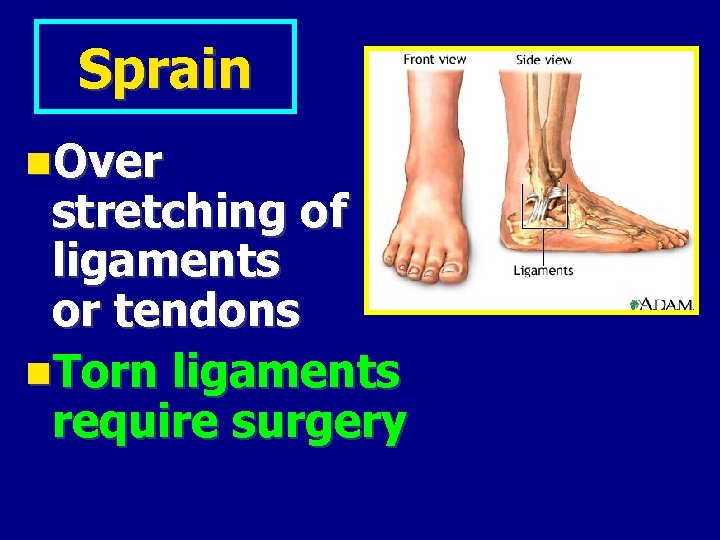 Sprain Over stretching of ligaments or tendons Torn ligaments require surgery 
