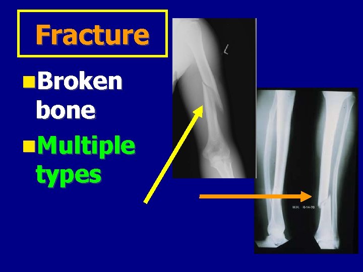 Fracture Broken bone Multiple types 