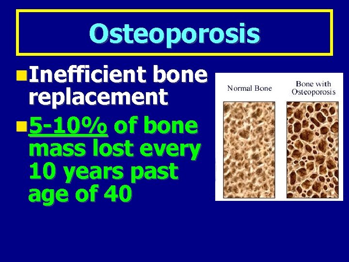 Osteoporosis Inefficient bone replacement 5 -10% of bone mass lost every 10 years past