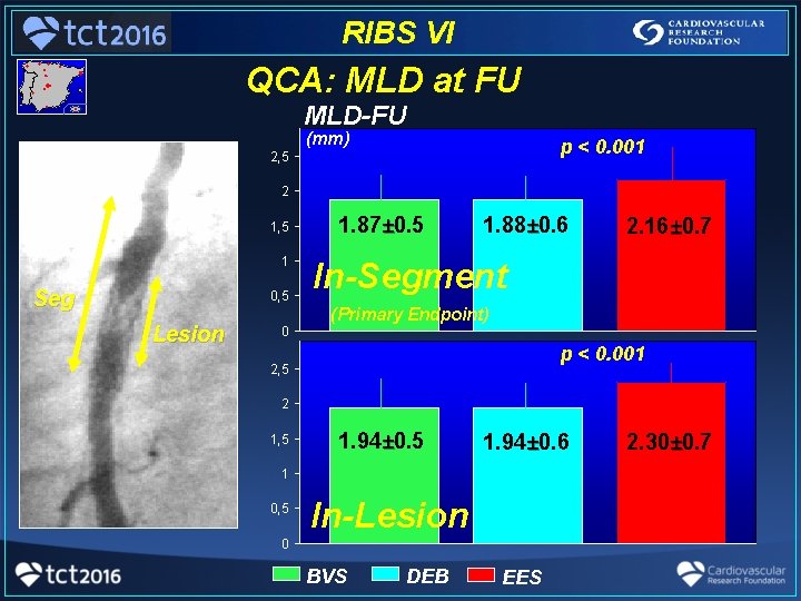 RIBS VI QCA: MLD at FU MLD-FU (mm) p < 0. 001 2, 5