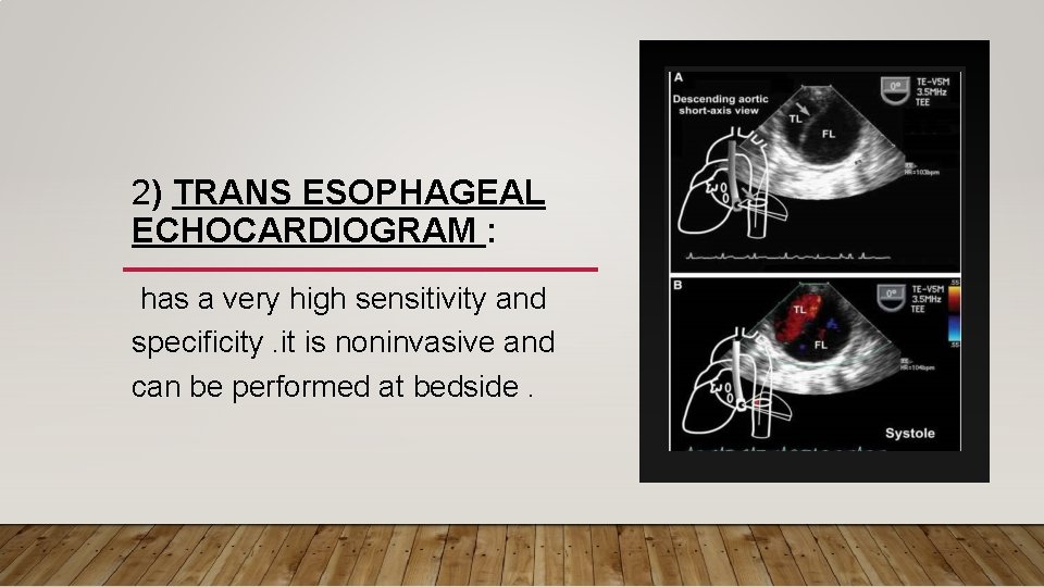 2) TRANS ESOPHAGEAL ECHOCARDIOGRAM : has a very high sensitivity and specificity. it is 2) TRANS ESOPHAGEAL ECHOCARDIOGRAM : has a very high sensitivity and specificity. it is