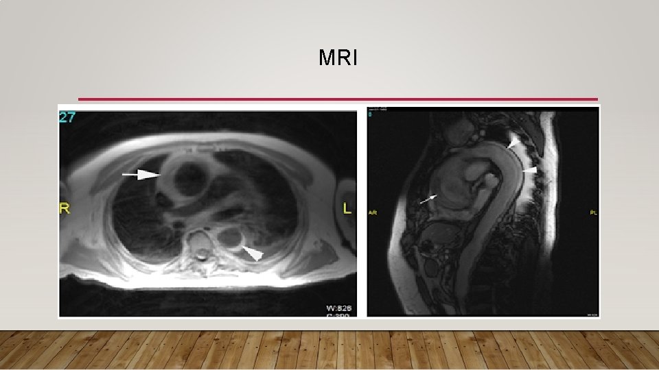 MRI MRI