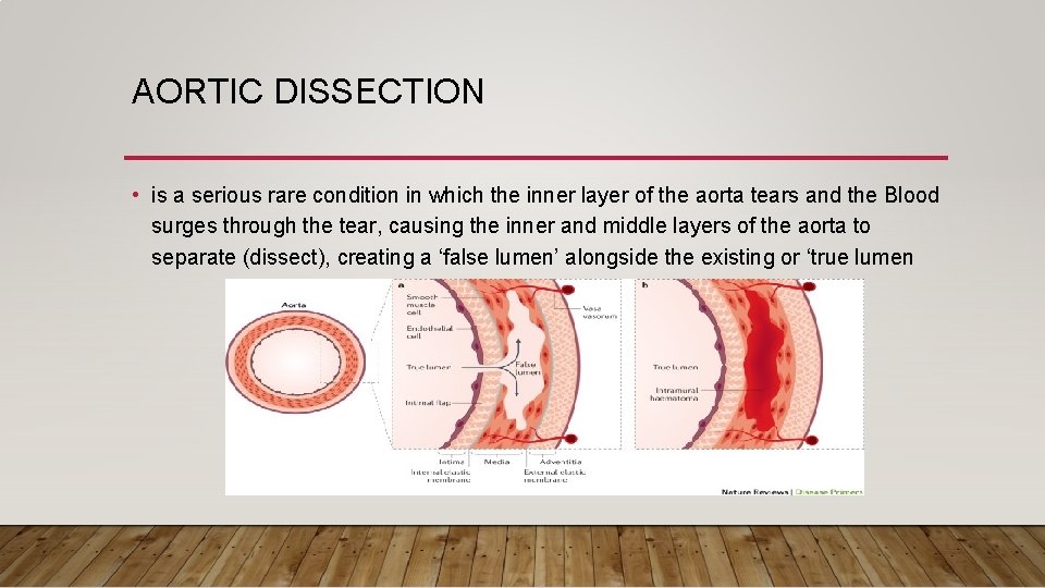 AORTIC DISSECTION • is a serious rare condition in which the inner layer of AORTIC DISSECTION • is a serious rare condition in which the inner layer of