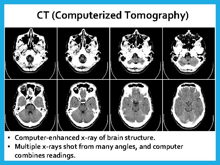 CT (Computerized Tomography) • Computer-enhanced x-ray of brain structure. • Multiple x-rays shot from