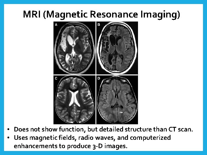MRI (Magnetic Resonance Imaging) • Does not show function, but detailed structure than CT
