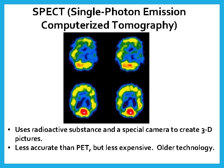 SPECT (Single-Photon Emission Computerized Tomography) • Uses radioactive substance and a special camera to