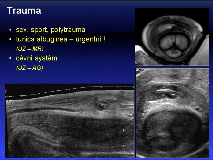 Trauma • sex, sport, polytrauma • tunica albuginea – urgentní ! (UZ – MR)