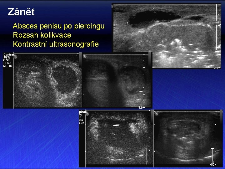 Zánět Absces penisu po piercingu Rozsah kolikvace Kontrastní ultrasonografie 