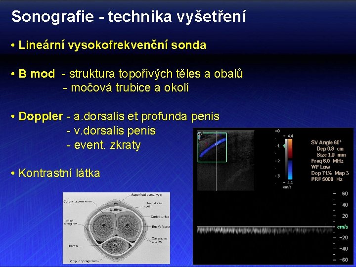 Sonografie - technika vyšetření • Lineární vysokofrekvenční sonda • B mod - struktura topořivých