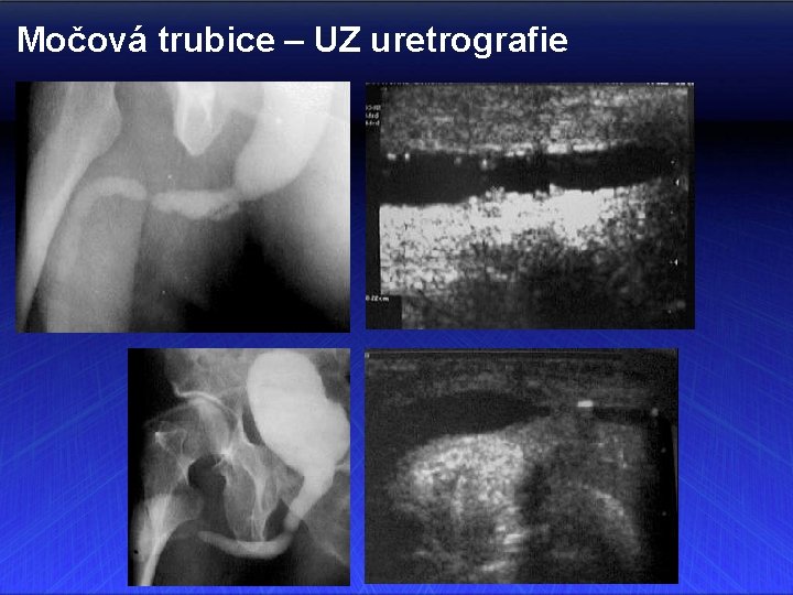 Močová trubice – UZ uretrografie 