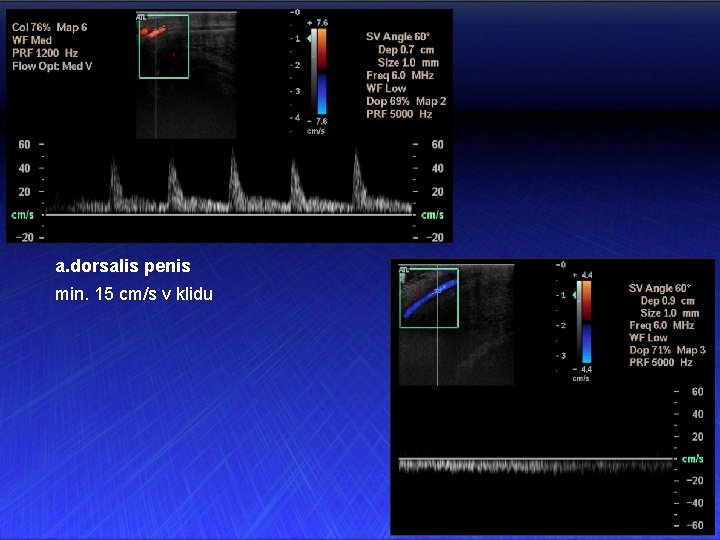 a. dorsalis penis min. 15 cm/s v klidu 
