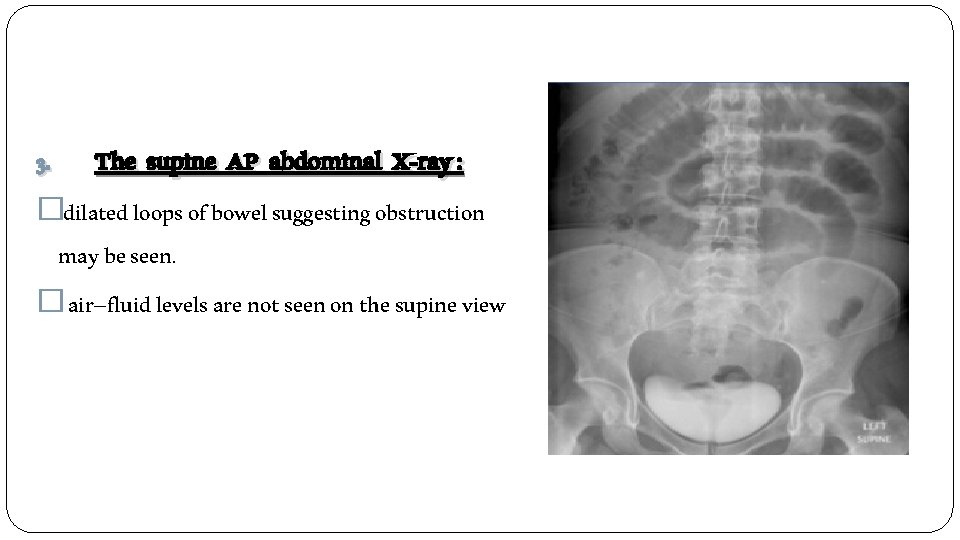 3. The supine AP abdominal X-ray : �dilated loops of bowel suggesting obstruction may
